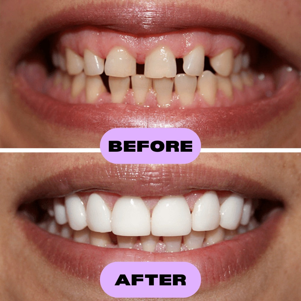 Flex-Smile® Veneers