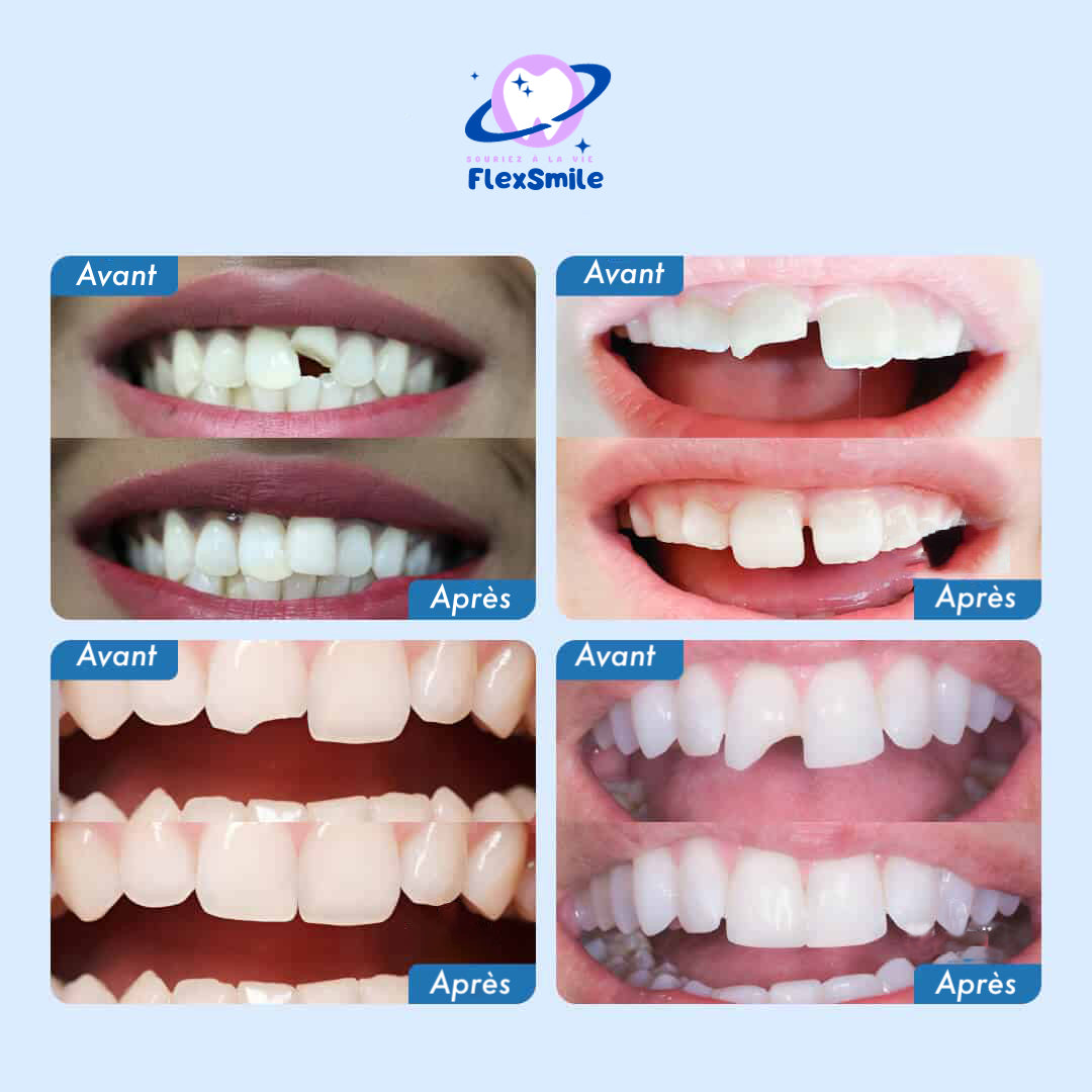 Flex-Smile® - Dental Repair Kit